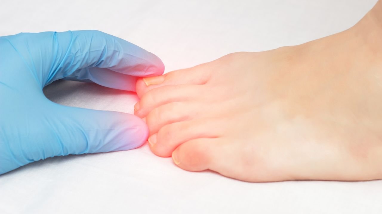 Ingrown Toenails and Incurvated Nails: The Bronx's Leading Podiatry Solutions 5 Achieving Beautiful Feet: A Comprehensive Guide to Managing Ugly Toenails