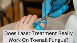 Does Laser Treatment Really Work On Toenail Fungus?