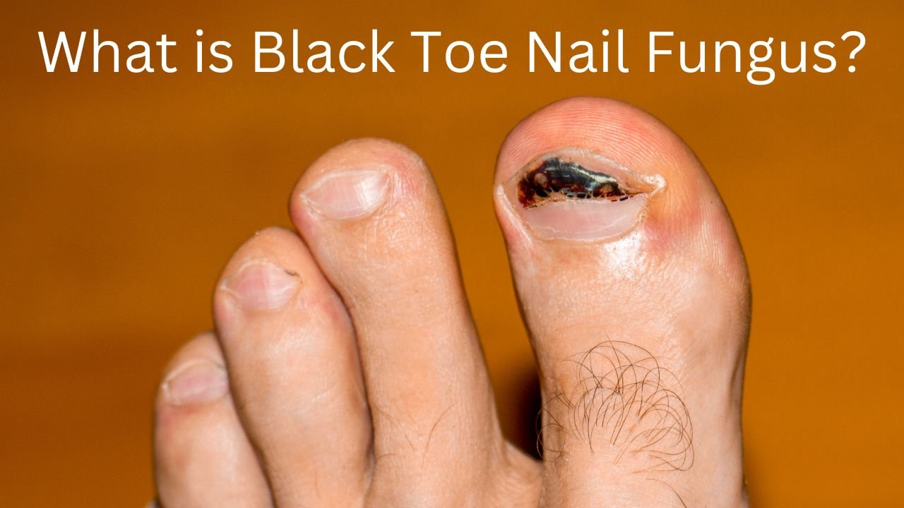 Ingrown Toenails and Incurvated Nails: The Bronx's Leading Podiatry Solutions 3 What is black toe nail fungus