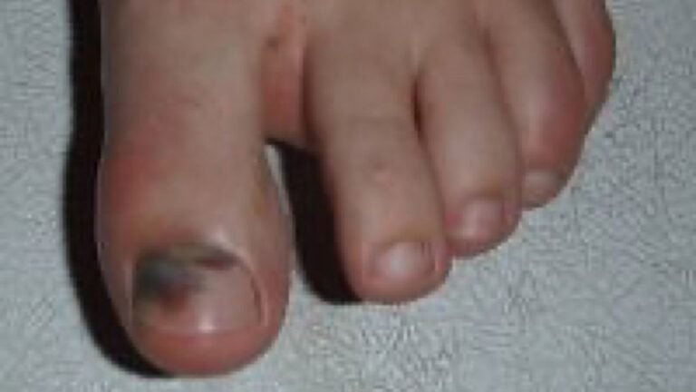 What is black toe nail fungus?