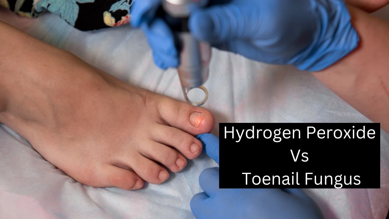 Can Hydrogen Peroxide Kill Toenail Fungus the Fastest