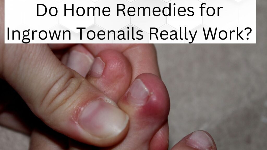 Do Home Remedies for Ingrown Toenails Really Work? 1 Do Home Remedies for Ingrown Toenails Really Work