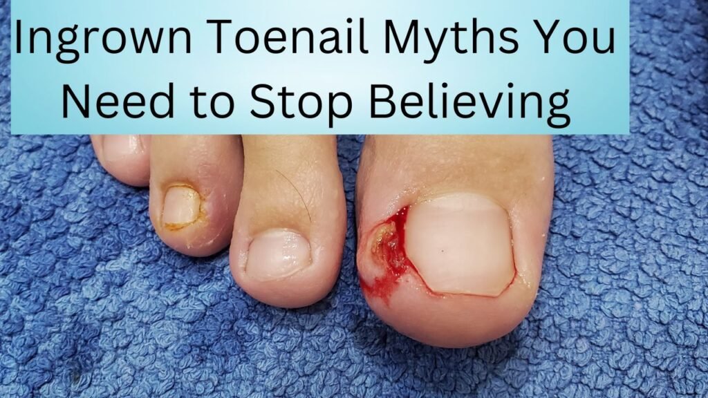 Ingrown Toenail Myths You Need to Stop Believing 1 Ingrown Toenail Myths You Need to Stop Believing
