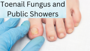 Toenail Fungus and Public Showers: How to Stay Safe