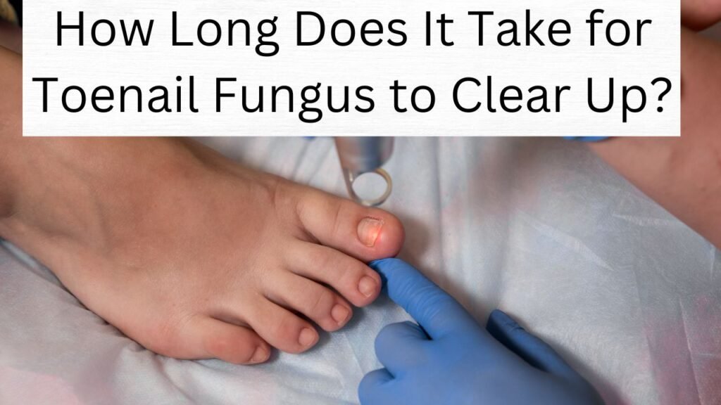 How Long Does It Take for Toenail Fungus to Clear Up?