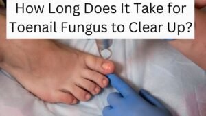 How Long Does It Take for Toenail Fungus to Clear Up?