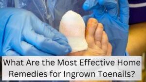 What Are the Most Effective Home Remedies for Ingrown Toenails?