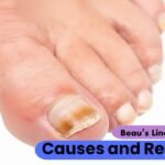 Beau’s Lines on Toenails: Causes, Recovery, and What Your Nails Are Telling You