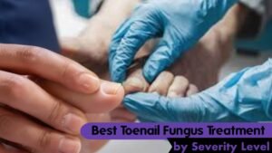 Best Toenail Fungus Treatment by Severity Level