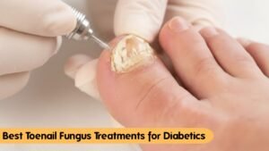 Best Toenail Fungus Treatments for Diabetics : Safe, Doctor-Approved Options That Protect Your Feet