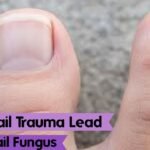 Does Nail Trauma Lead to Toenail Fungus? What Really Happens After an Injury