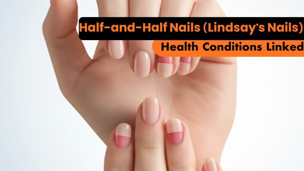 Half-and-Half Nails (Lindsay’s Nails): 5 Health Conditions You Shouldn’t Ignore 1 Half-and-Half Nails (Lindsay’s Nails): Health Conditions Linked