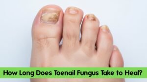 How Long Does Toenail Fungus Take to Heal? The Real Timeline Nobody Explains
