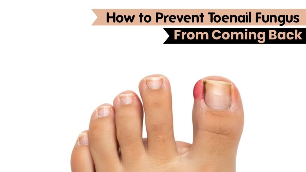 How to Prevent Toenail Fungus From Coming Back 1 How to Prevent Toenail Fungus From Coming Back
