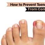 How to Prevent Toenail Fungus From Coming Back