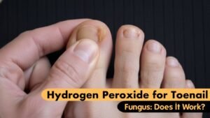 Hydrogen Peroxide for Toenail Fungus: Does It Really Work?