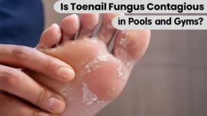 Is Toenail Fungus Contagious in Pools and Gyms? What Really Puts You at Risk