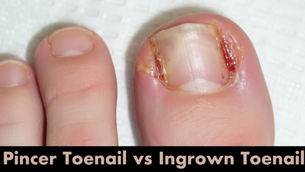 Pincer Toenail vs Ingrown Toenail: Key Differences