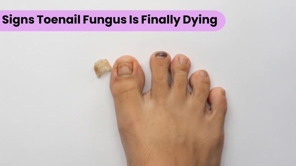7 Proven Signs Your Toenail Fungus Is Finally Dying 1 Signs Toenail Fungus Is Finally Dying