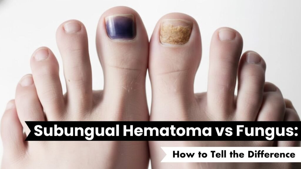 Subungual Hematoma vs Fungus: How to Tell the Difference (Before You Panic) 1 Subungual Hematoma vs Fungus: How to Tell the Difference
