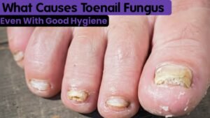 Why Do I Have Toenail Fungus Even With Good Hygiene?