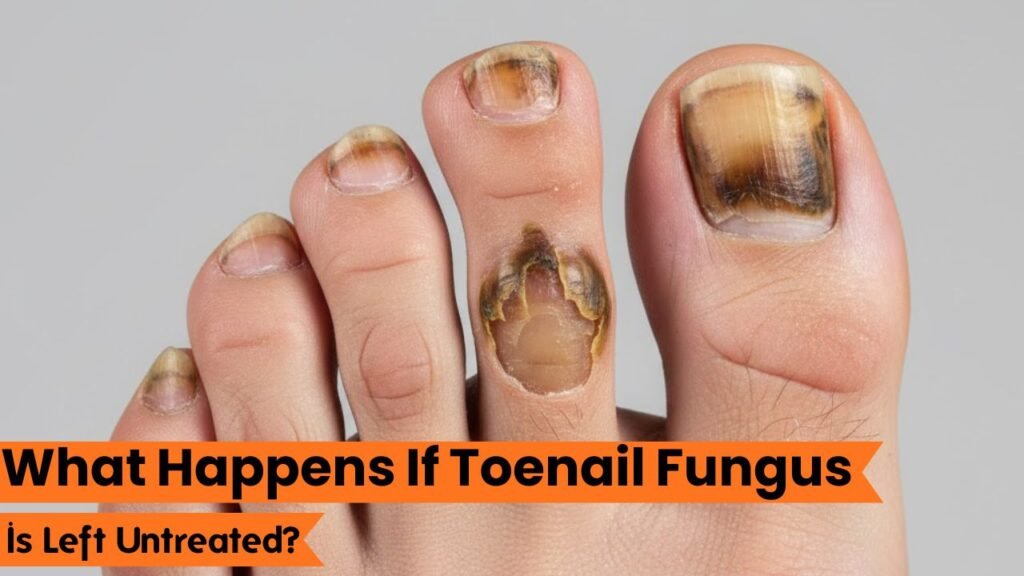 What Happens If Toenail Fungus Is Left Untreated? The Real Risks You Shouldn’t Ignore 1 Current image: What Happens If Toenail Fungus Is Left Untreated?