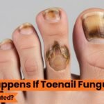 What Happens If Toenail Fungus Is Left Untreated? The Real Risks You Shouldn’t Ignore