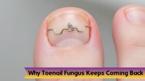 Why Toenail Fungus Keeps Coming Back (Even After Treatment): The Real Reasons Explained