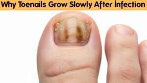 Why Toenails Grow So Slowly After Infection