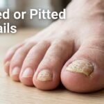 Dented or Pitted Toenails Meaning