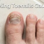 Peeling Toenails Causes – Complete Expert Guide