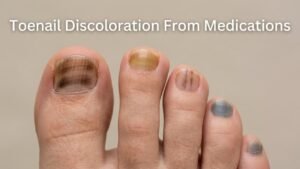 Toenail Discoloration From Medications