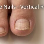 Brittle Nails Vertical Ridges - Nutrient Deficiency or Fungal Infection