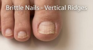 Brittle Nails Vertical Ridges – Nutrient Deficiency or Fungal Infection?