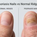 Psoriasis Nails vs Normal Ridges - How to Tell the Difference