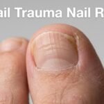 Toenail trauma nail ridges