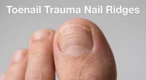 Toenail Trauma Explained – How Shoes and Pressure Cause Nail Ridges